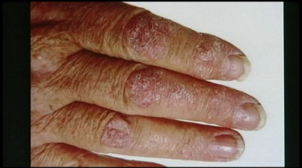 Psoriasis and heat