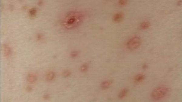 Measles outbreak causes concern