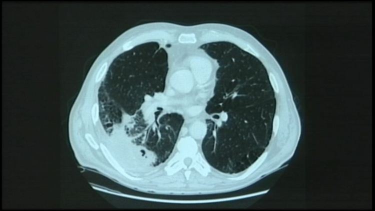 CT scans may scare smokers into quitting