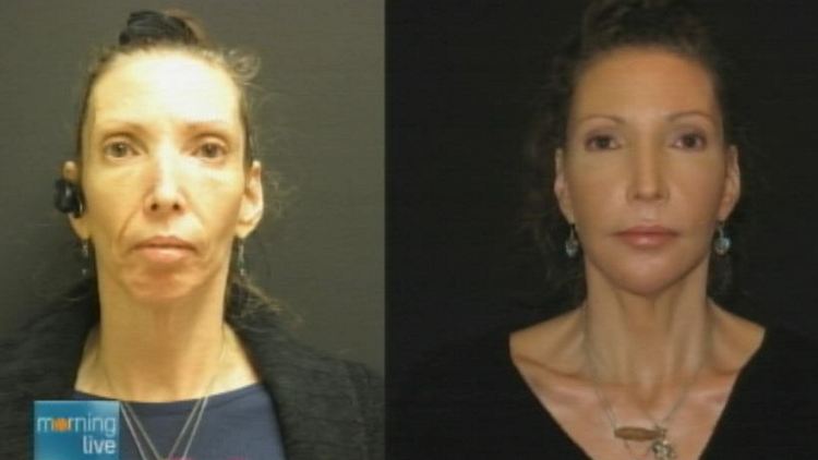 Before-and-after image of a woman undergoing Bellafill treatment