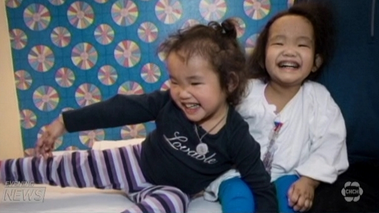 Twin doing well after liver transplant: docs