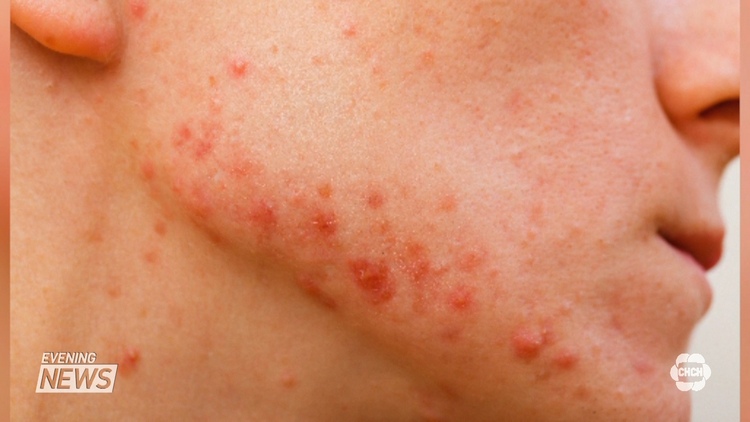 Acne on a teenage boy's face