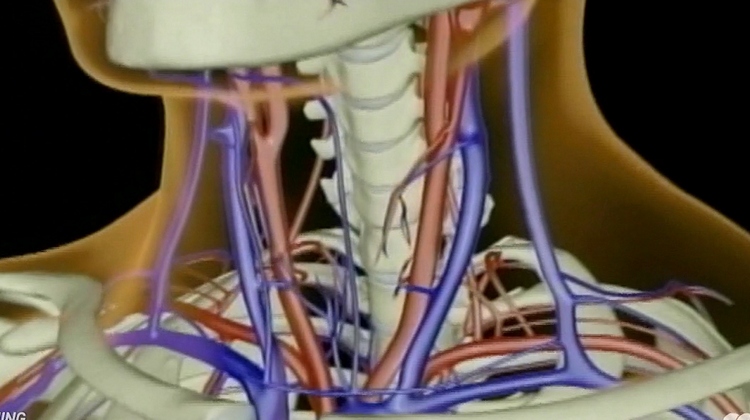 LIberation treatment for multiple sclerosis