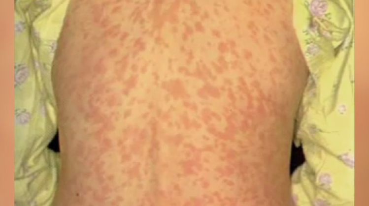 Confirmed case of measles in Niagara