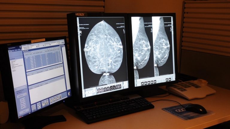 Accessible mammograms