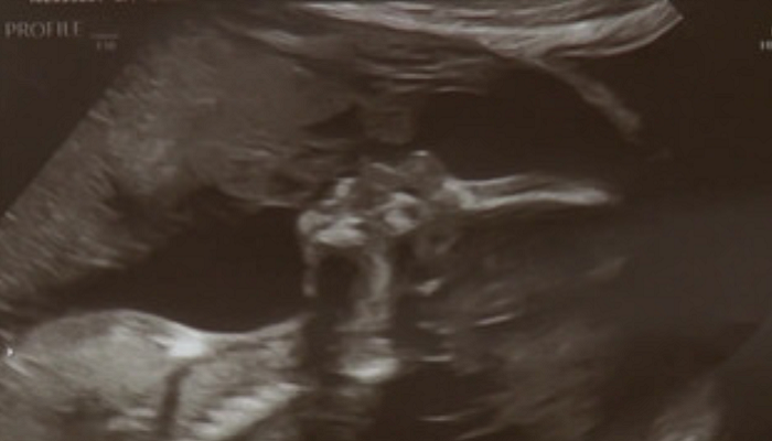 California woman sees late father in ultrasound photo (VIDEO)