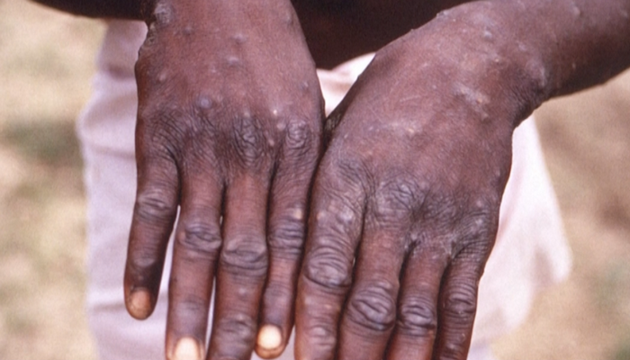 Infectious disease specialist explains what monkeypox is