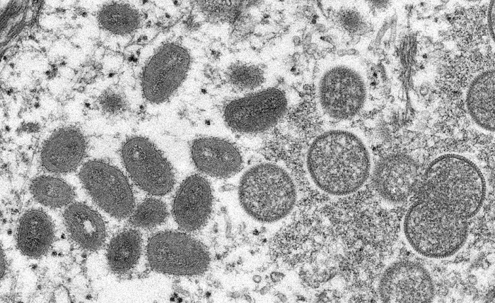 First case of Monkeypox virus confirmed in Niagara Region