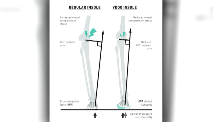 Kintec’s custom VDOO insole offers relief of knee osteoarthritis