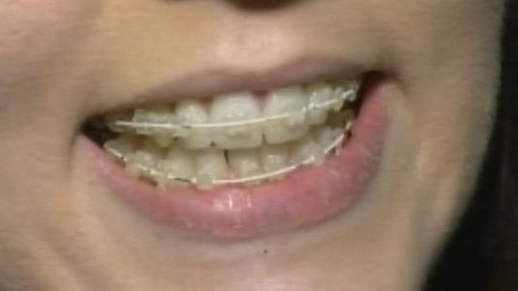 Woman with invisible braces at Alton Dental; Morning Live, January 12, 2015