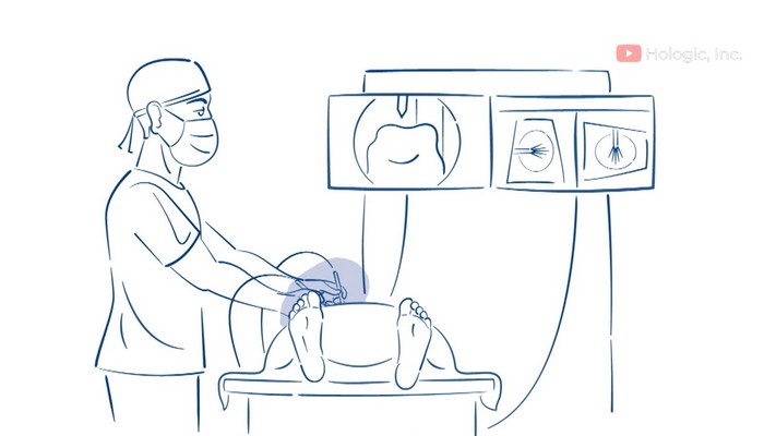 fibroids