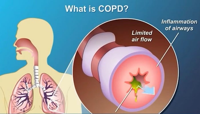 COPD